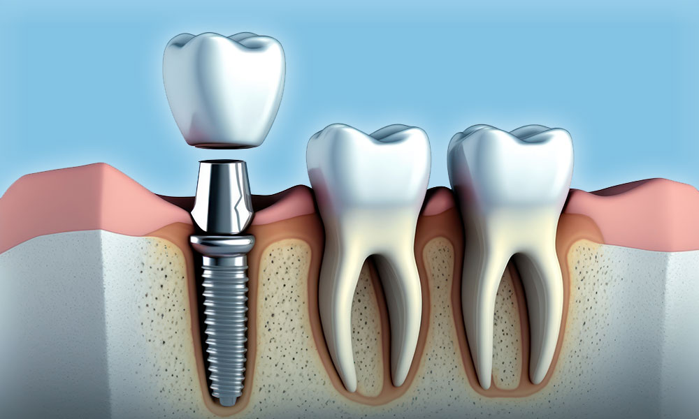dentalimplant-2
